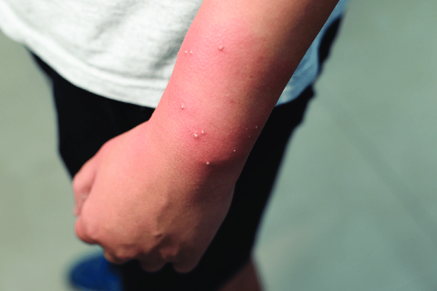 fire ant sting